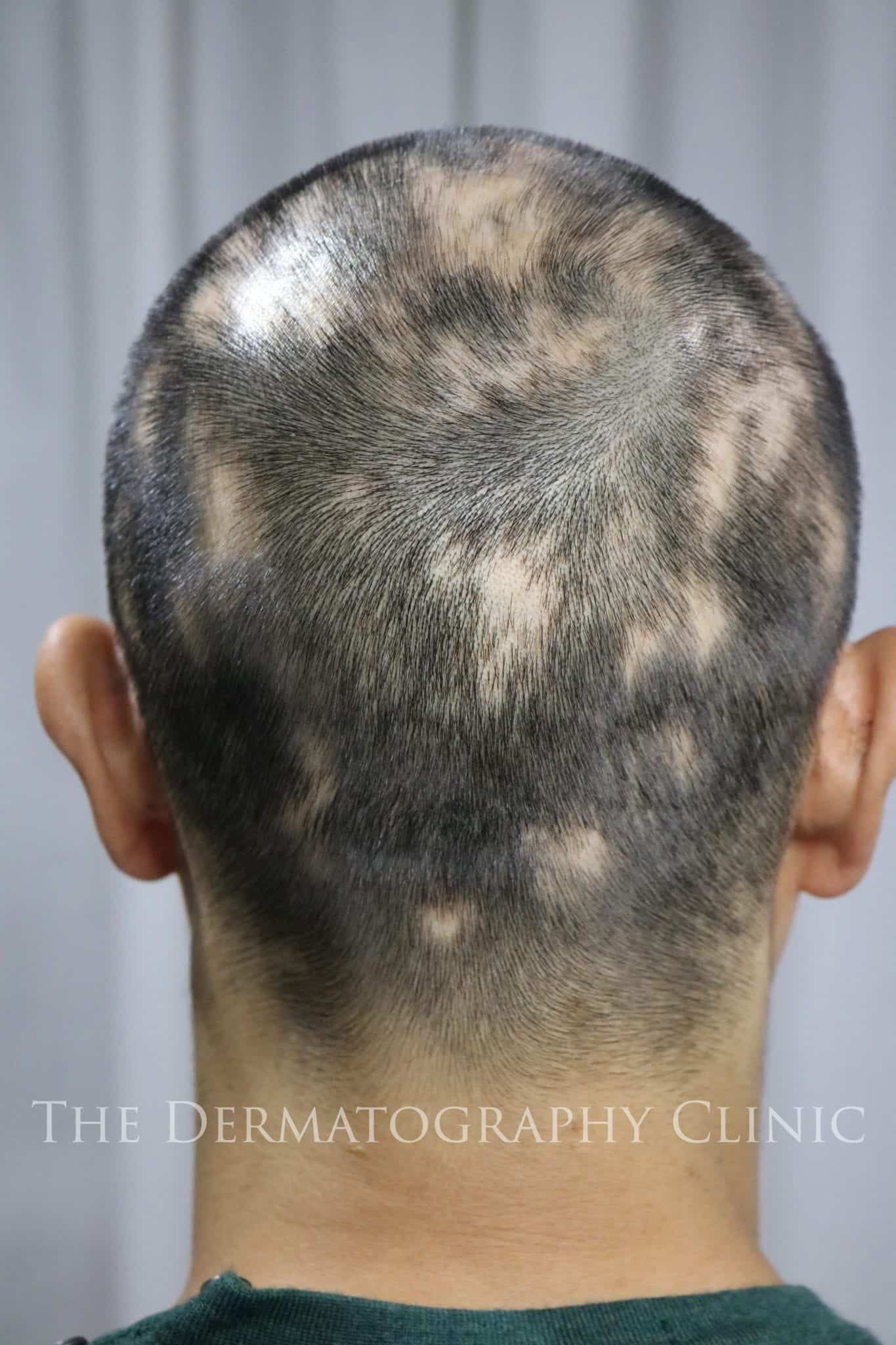 Alopecia Treatments For Men The Dermatography Clinic