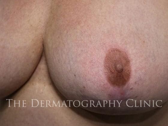 nipple tattoo after photo