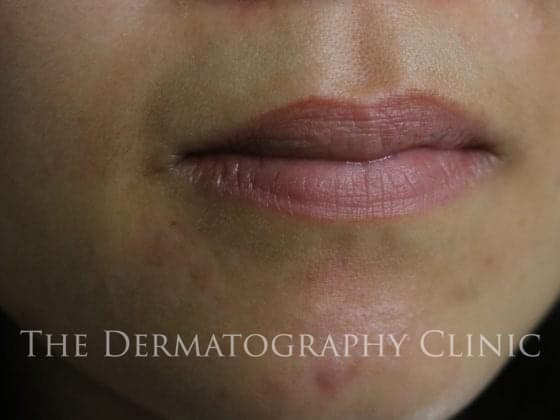 Permanent Lip Colour Before and After