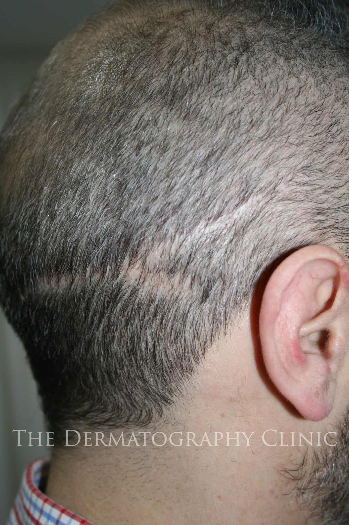 FUT Scar Cover-Up - The Dermatogaphy Clinic