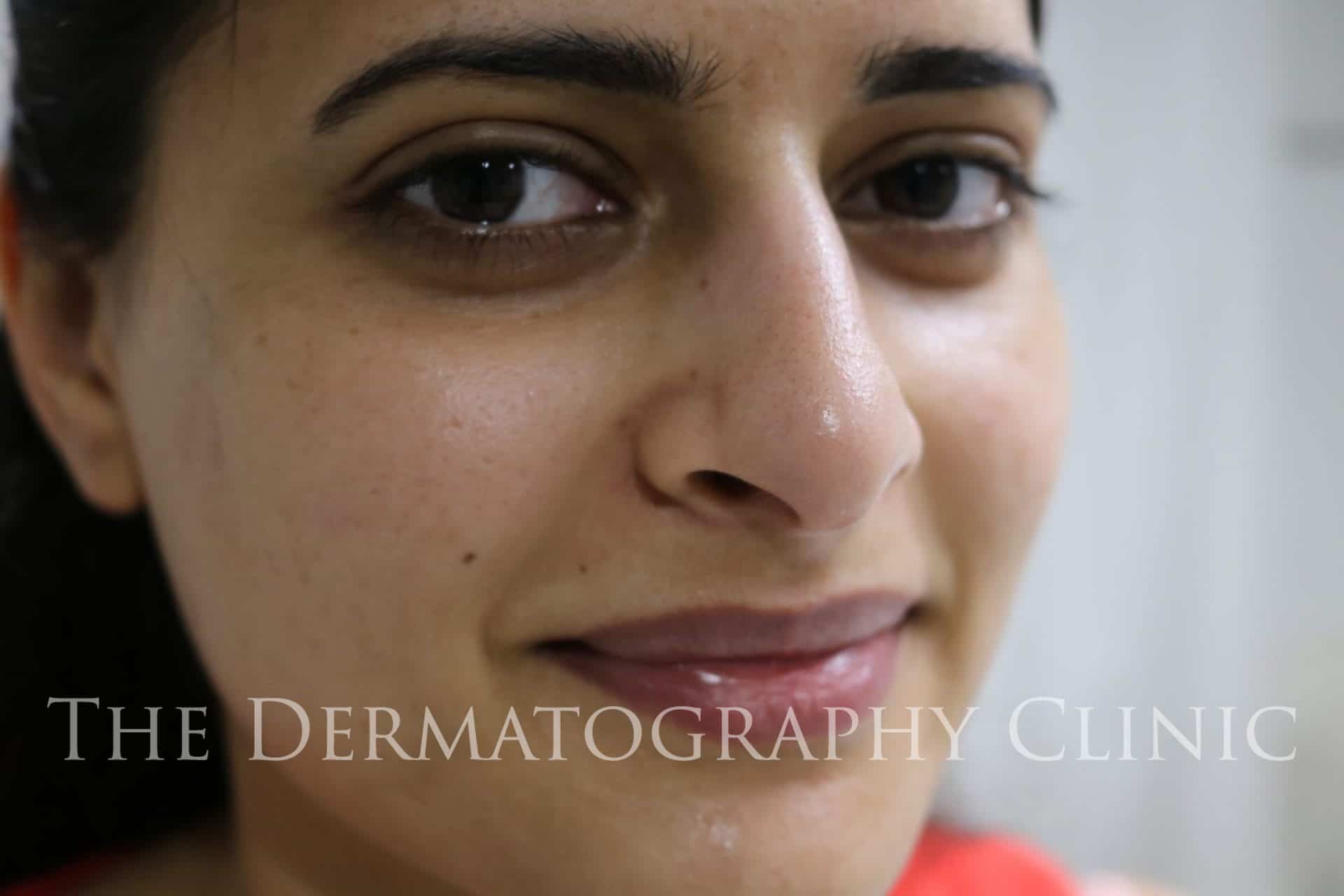 Facial Scar  Mole Revision in Mumbai  Tattoo Removal  Bombay Cosmetic  Clinics