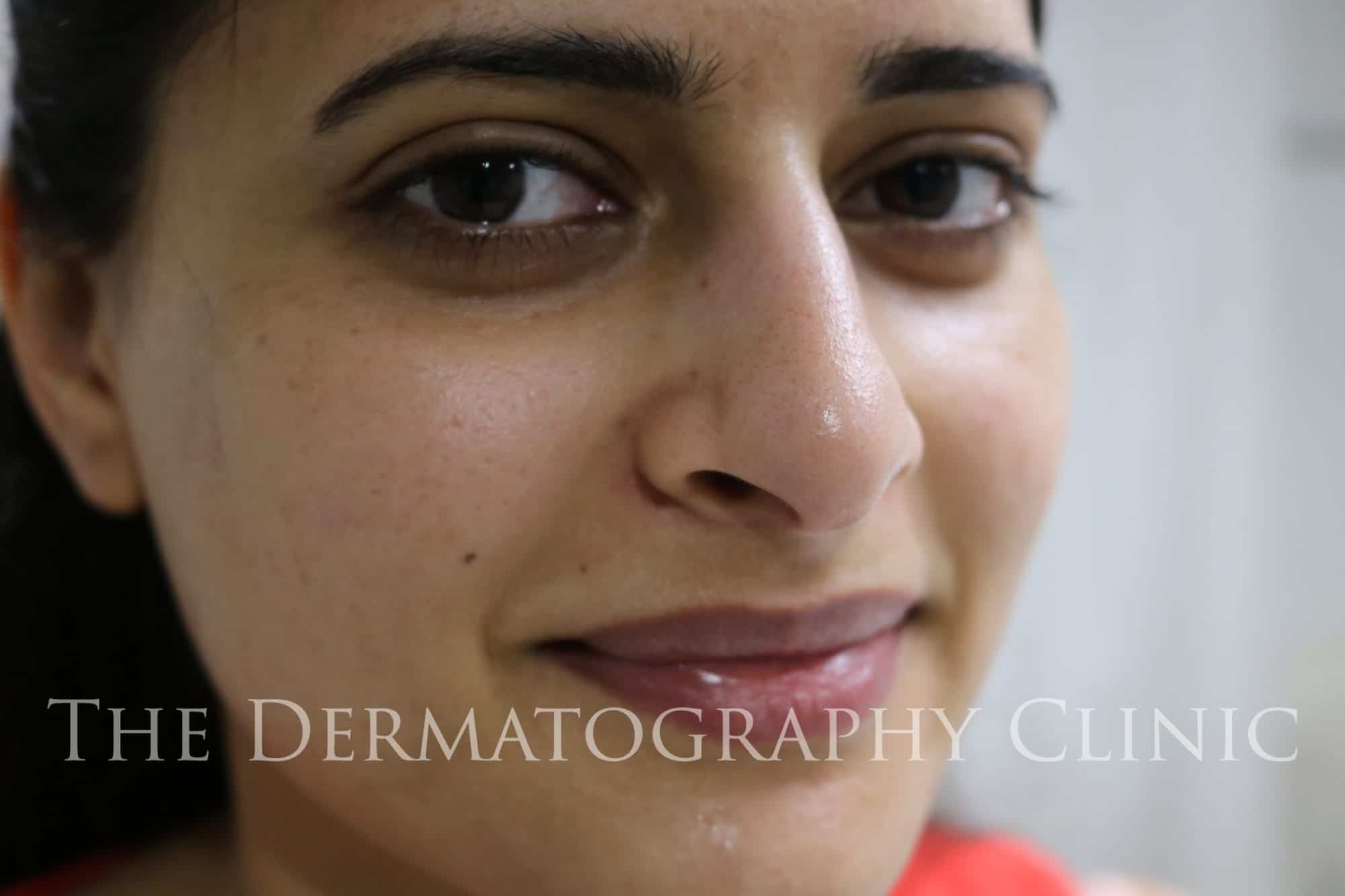 Beauty Spot Tattoo - The Dermatography Clinic