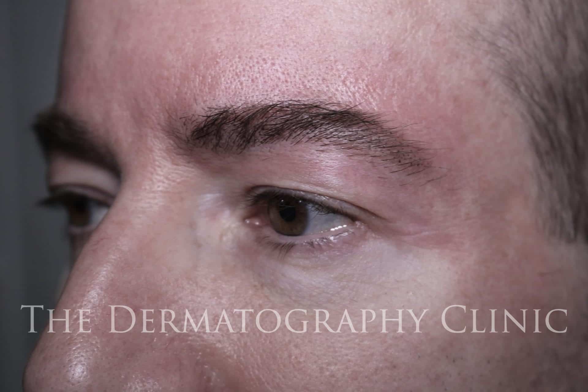 Eyebrow Tattoo For Men - The Dermatography Clinic