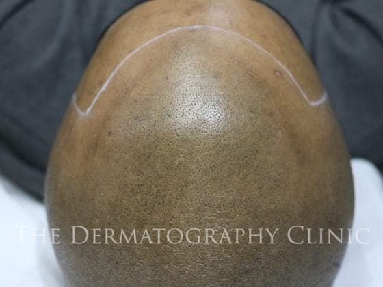 best scalp micropigmentation london