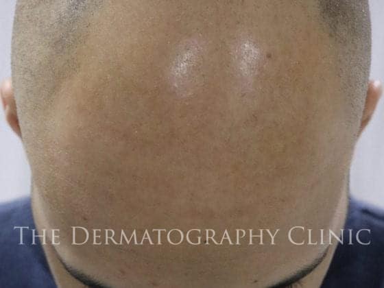 scalp micropigmentation for crown balding