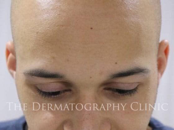 scalp micropigmentation for receding hairline