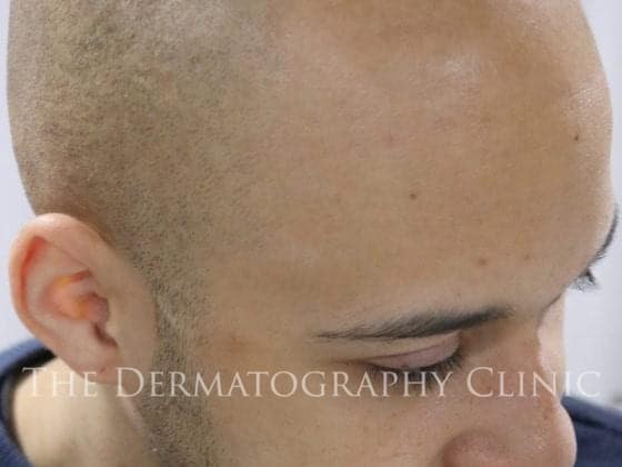 scalp micropigmentation for receding hairline