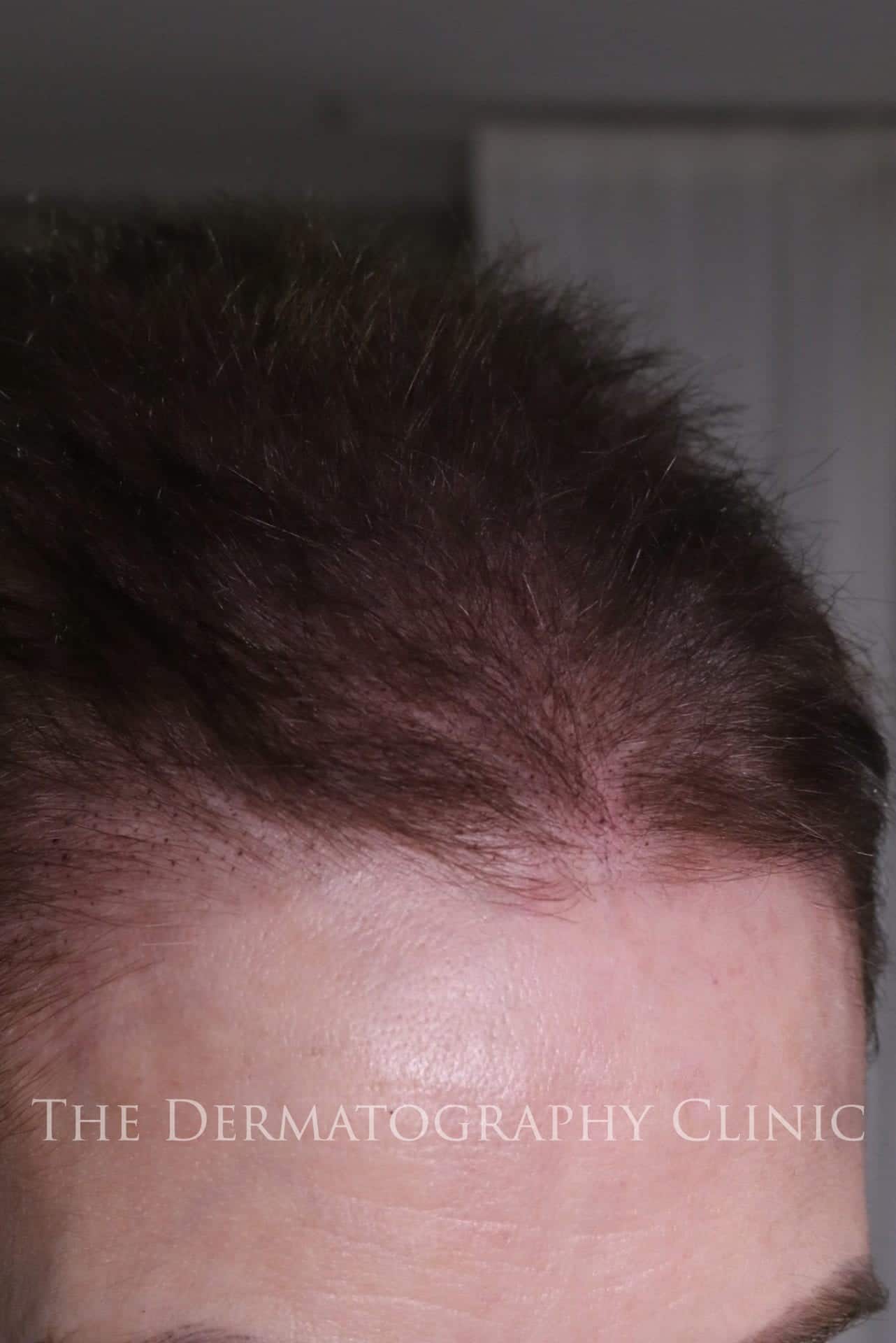 If you get the forehead hair tattoo you will look much more younger This  session is best for people who has complex on their big forehead losing  hair   HairlinePigmentation akimadison 