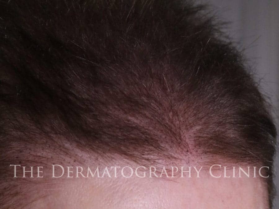 Scalp Micropigmentation For Women - The Dermatography Clinic