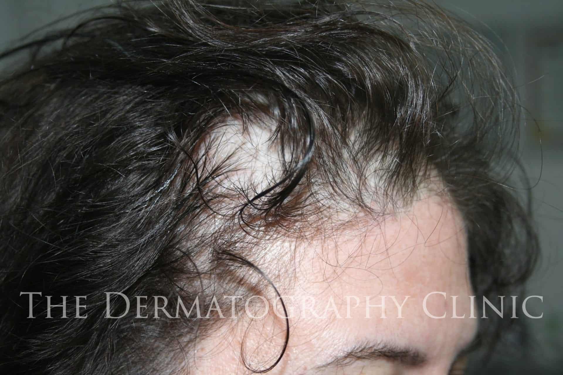 Female Hairline Lowering  Cocoona Clinic Dubai