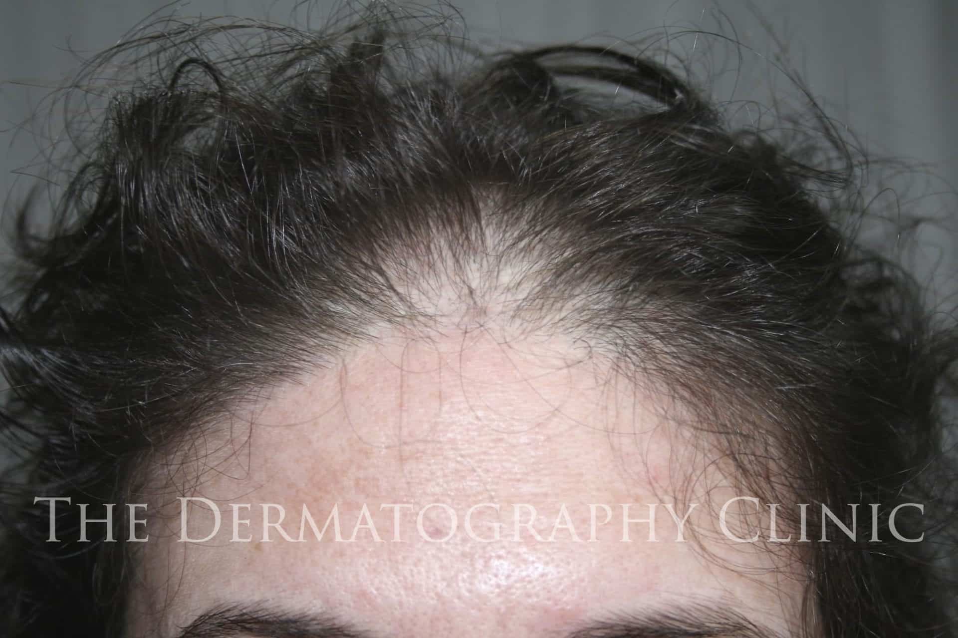 Reasons to Choose Scalp Micropigmentation in Fairfield, CT