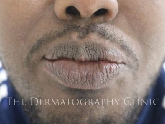 Vitiligo Tattoo - The Dermatography Clinic