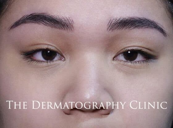 Permanent Eyebrows After Treatment Photo