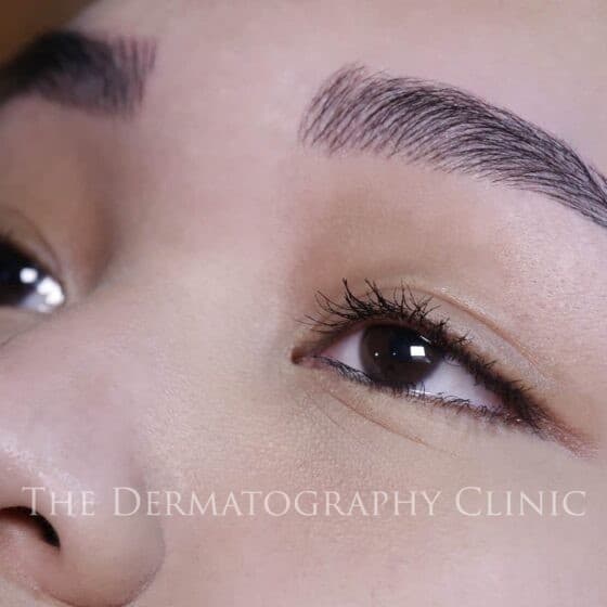 Close-up image of Nano Stroke eyebrow treatment results