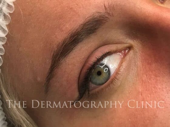 Permanent Eyeliner After Treatment Photo