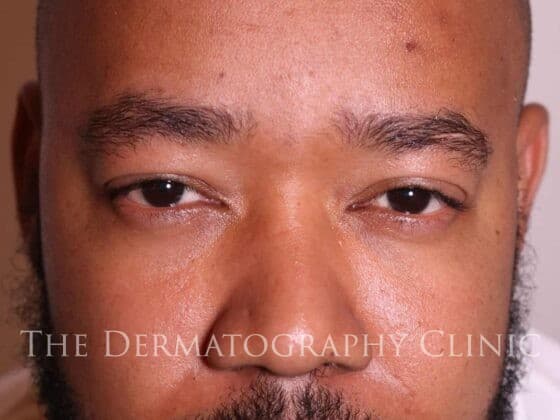 Scalp Micropigmentation for men after treatment photo