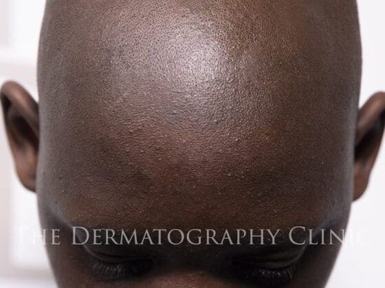 Alopecia In Men After Treatment