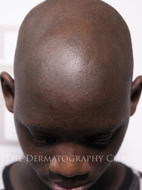 Alopecia In Men After Treatment