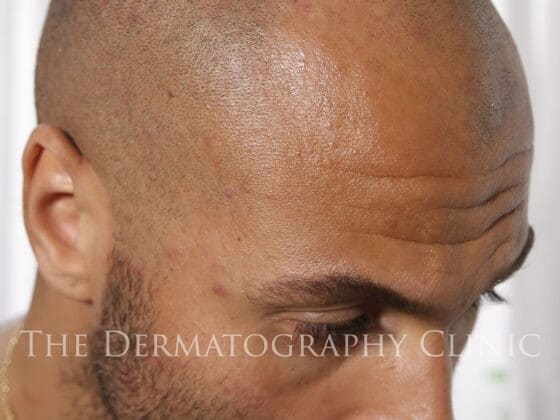 Scalp Micropigmentation Before Treatment