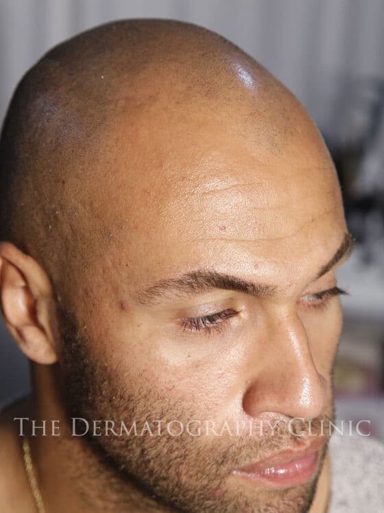 Oliver Scalp Micropigmentation Treatment