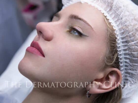 Permanent Eyeliner During Treatment Photo