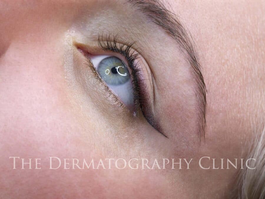 Permanent Eyeliner The Dermatography Clinic