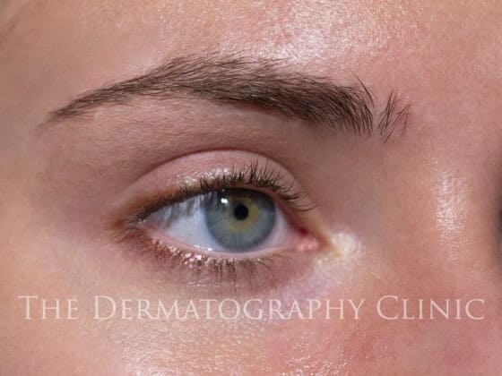 Permanent Eyeliner Treatment Photo
