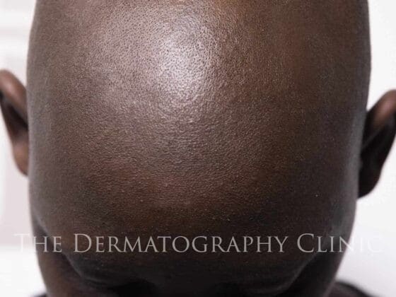 Alopecia In Men After Photo