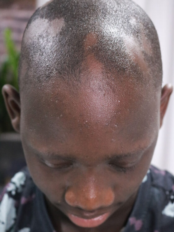 Alopecia In Men Before Photo