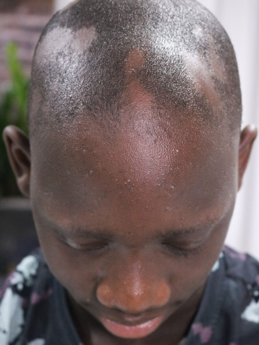 alopecia universalis homeopathic treatment