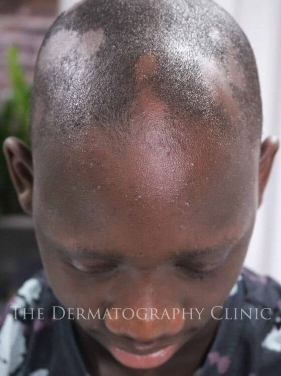 Alopecia In Men - Alopecia Camouflage The Treatment