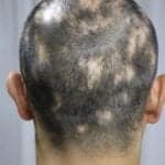Male Alopecia Treatment