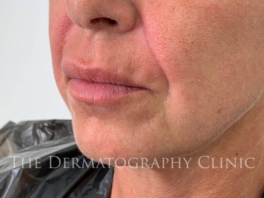 No Needle Dermal Fillers The Dermatography Clinic