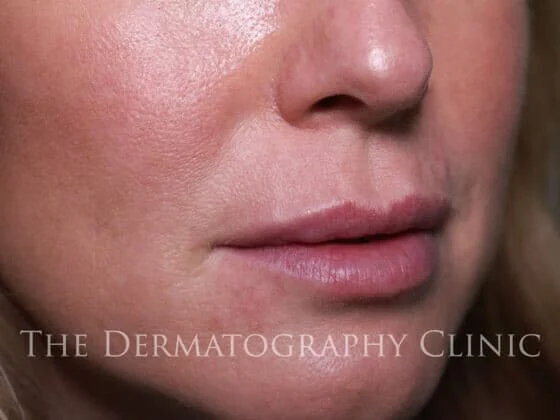 Before and After Needle-Free Lip Filler