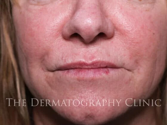 Before and After Needle-Free Smile Line and Lip Filler