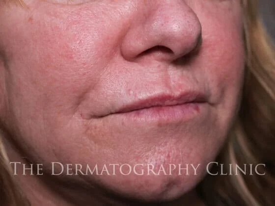 Before and After Needle-Free Smile Line and Lip Filler