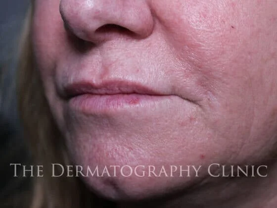 Before and After Needle-Free Smile Line and Lip Filler