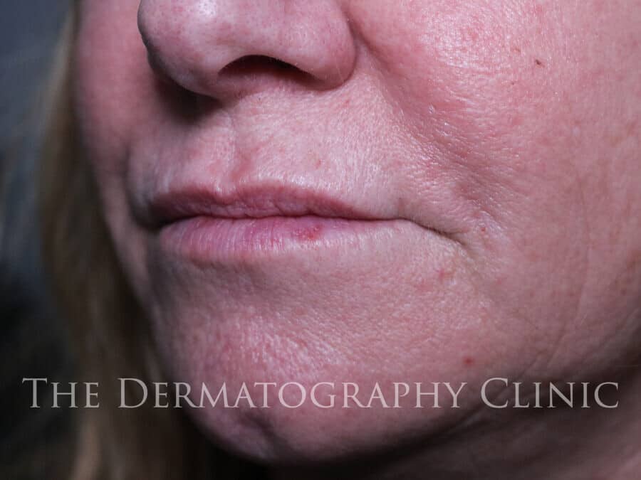 No Needle Dermal Fillers The Dermatography Clinic