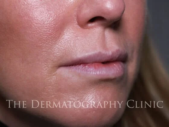Before and After Needle-Free Lip Filler