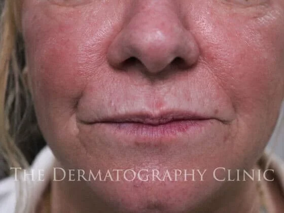 Before and After Needle-Free Smile Line and Lip Filler