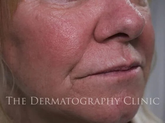 Before and After Needle-Free Smile Line and Lip Filler