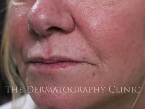 Before and After Needle-Free Smile Line and Lip Filler