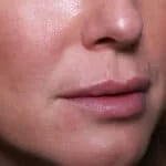 Before and After Needle-Free Lip Filler