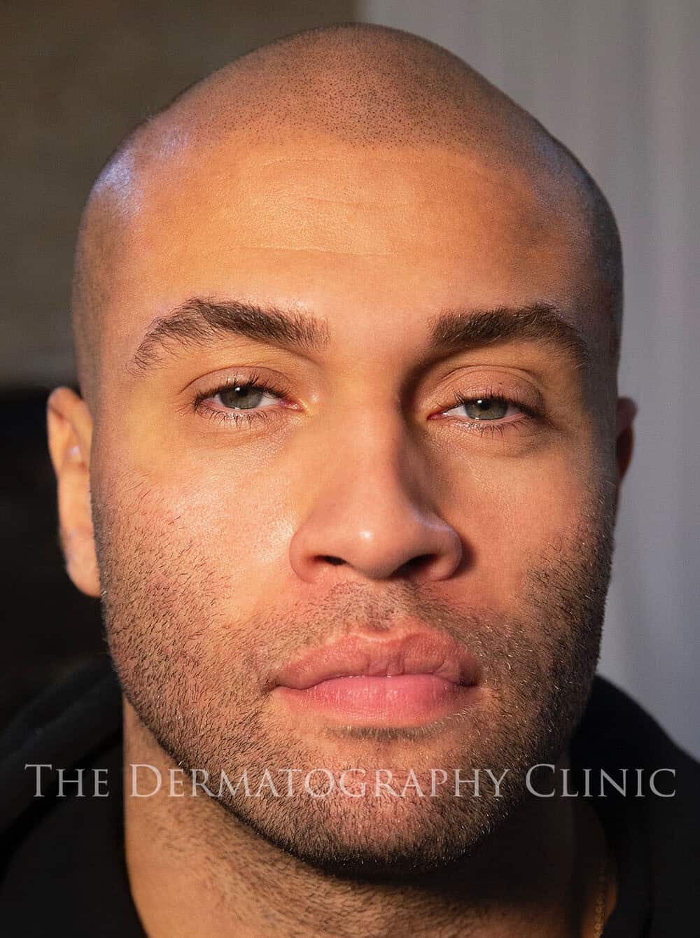 Scalp Micropigmentation 1b