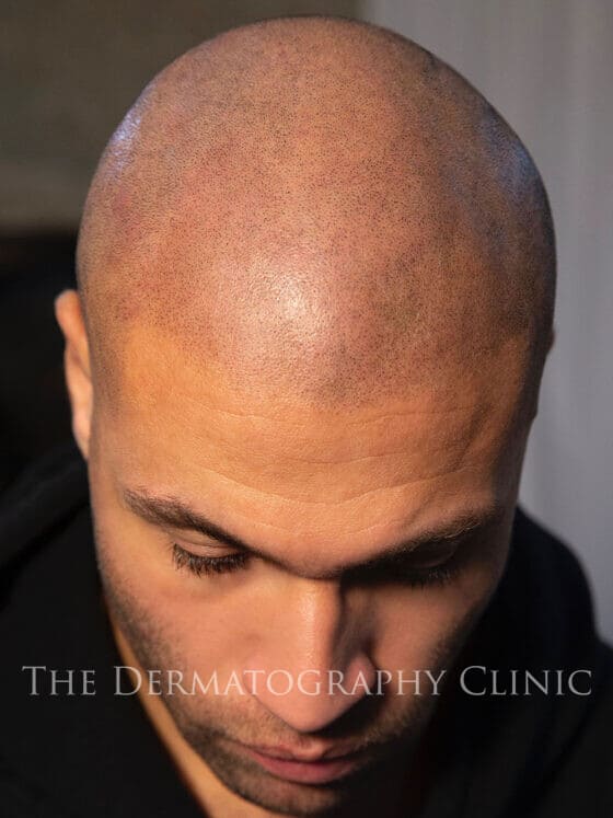 Scalp Micropigmentation 2b