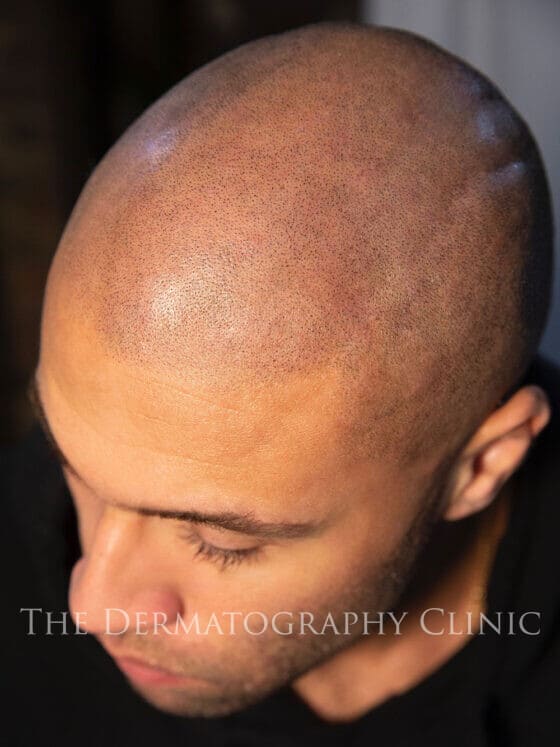 Scalp Micropigmentation 3b