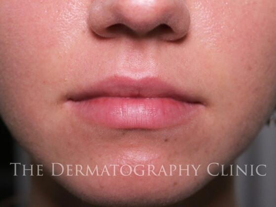 No Needle Dermal Fillers Before Treatment