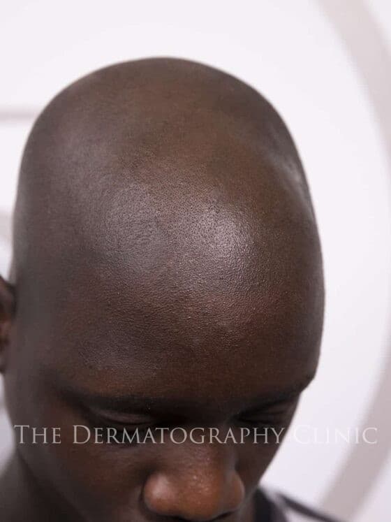 Alopecia In Men top of head photo
