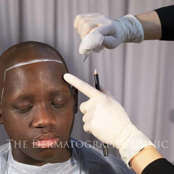 Male alopecia medical video screenshot