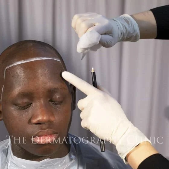 Male alopecia medical video screenshot
